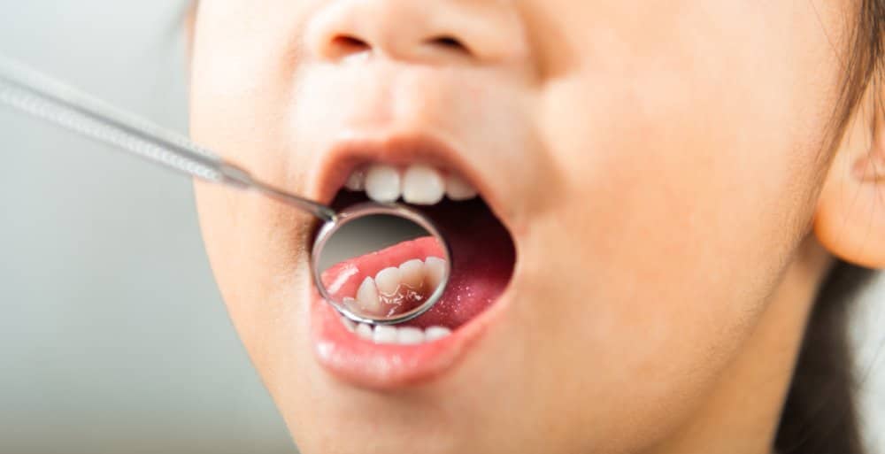 Orthodontic treatment in a child